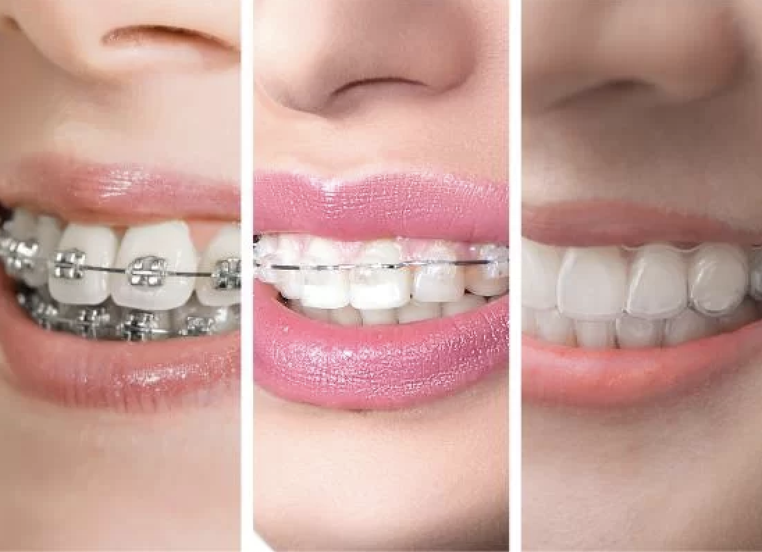 Niềng Răng Trong Suốt – Giải Pháp Thẩm Mỹ Mới Trong Chỉnh Nha